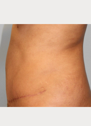 After Image: Abdominoplasty & Lipo-Dr.Tucker - left-side