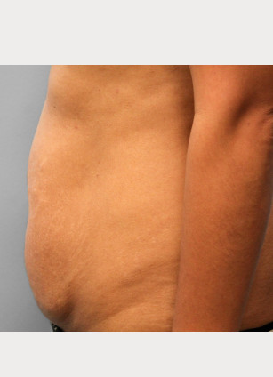 Before Image: Abdominoplasty & Lipo-Dr.Tucker - left-side