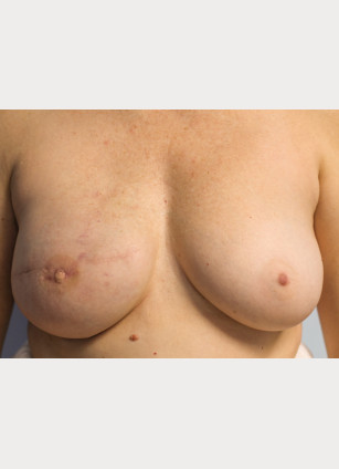 After Image: Breast Reconstruction-Dr.Tucker - front