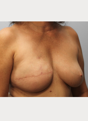 After Image: Breast Reconstruction-Dr.Tucker - right-front-oblique
