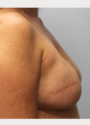After Image: Breast Reconstruction-Dr.Tucker - right-side
