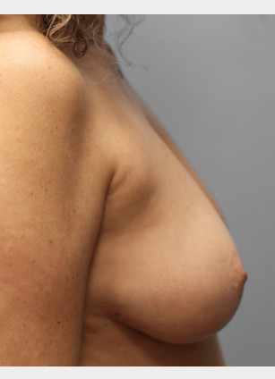 Before Image: Breast Reconstruction-Dr.Tucker - right-side