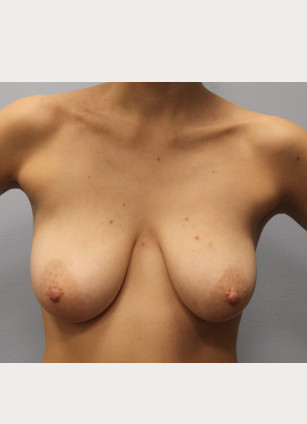 Before Image: Breast Augmentation & Lift- Dr. Howell - front