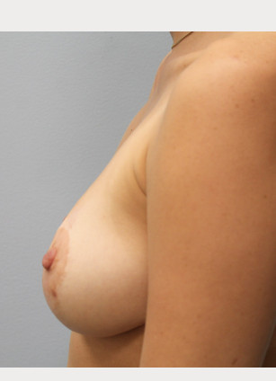 After Image: Breast Augmentation & Lift- Dr. Howell - left-side