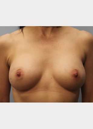 After Image: Breast Augmentation-Dr. Howell - front