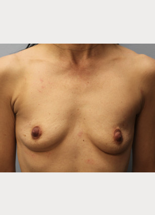 Before Image: Breast Augmentation-Dr. Howell - front