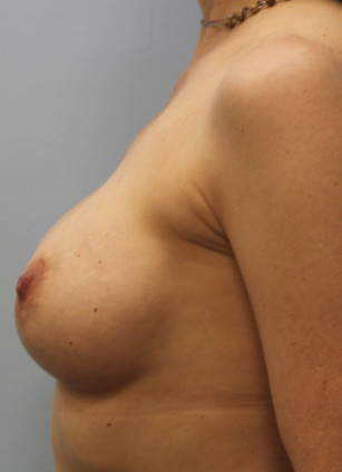 After Image: Breast Augmentation-Dr. Howell - left-side