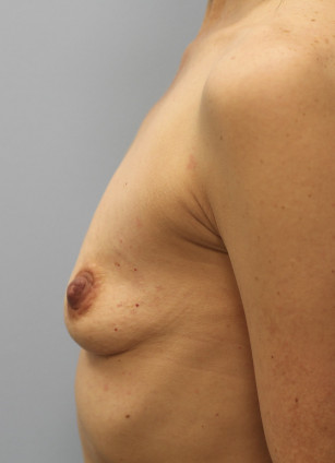 Before Image: Breast Augmentation-Dr. Howell - left-side