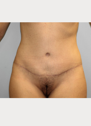 After Image: Abdominoplasty & Lipo- Dr. Howell - front