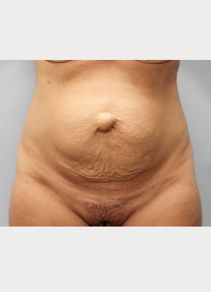Before Image: Abdominoplasty & Lipo- Dr. Howell - front