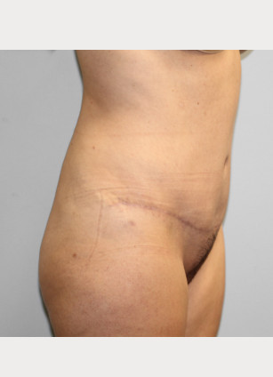 After Image: Abdominoplasty & Lipo- Dr. Howell - right-front-oblique