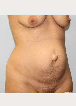 Before Image: Abdominoplasty & Lipo- Dr. Howell - right-front-oblique