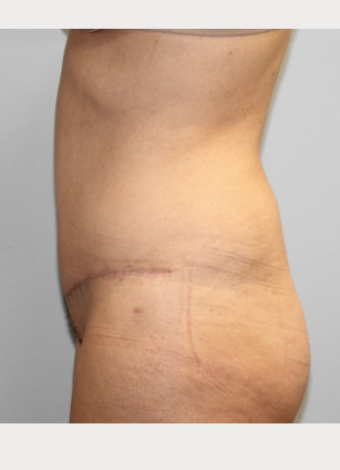 After Image: Abdominoplasty & Lipo- Dr. Howell - left-side