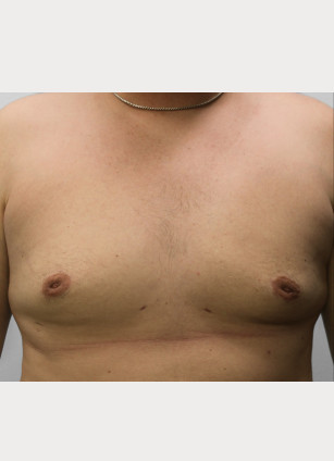 After Image: Gynecomastia-Dr. Howell - front