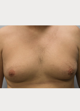 Before Image: Gynecomastia-Dr. Howell - front