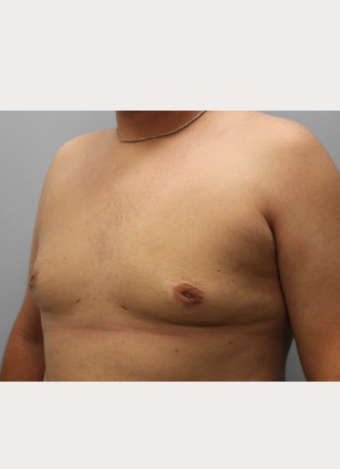 After Image: Gynecomastia-Dr. Howell - left-front-oblique