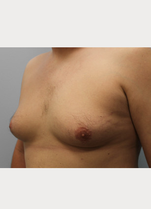 Before Image: Gynecomastia-Dr. Howell - left-front-oblique