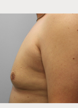 After Image: Gynecomastia-Dr. Howell - left-side