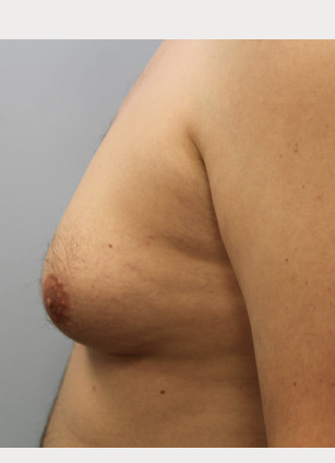 Before Image: Gynecomastia-Dr. Howell - left-side