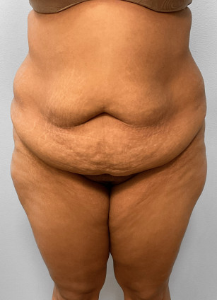 Abdominoplasty, Lipo, & BBL Injections-Dr. Howell
