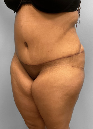 After Image: Abdominoplasty, Lipo, & BBL Injections-Dr. Howell - left-front-oblique