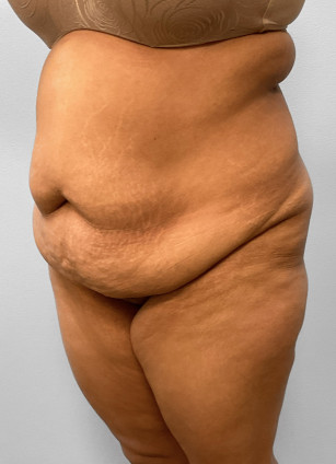 Before Image: Abdominoplasty, Lipo, & BBL Injections-Dr. Howell - left-front-oblique