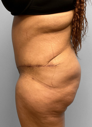 After Image: Abdominoplasty, Lipo, & BBL Injections-Dr. Howell - left-side