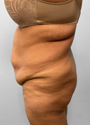 Before Image: Abdominoplasty, Lipo, & BBL Injections-Dr. Howell - left-side