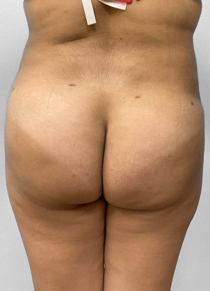 After Image: Liposuction & BBL Injections- Dr. Howell - back