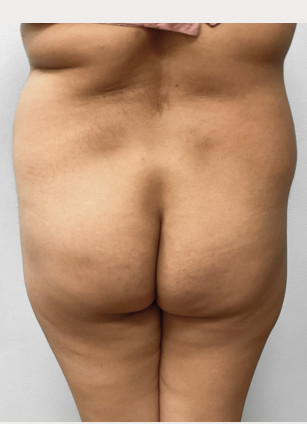 Before Image: Liposuction & BBL Injections- Dr. Howell - back