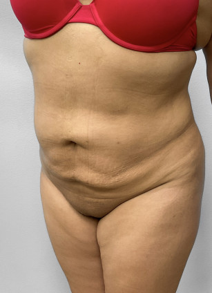 After Image: Liposuction & BBL Injections- Dr. Howell - left-front-oblique