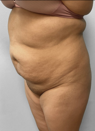 Before Image: Liposuction & BBL Injections- Dr. Howell - left-front-oblique