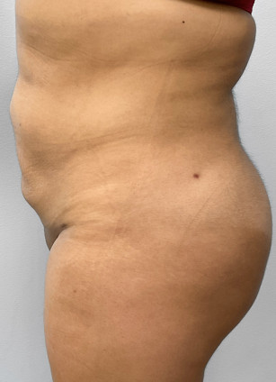 After Image: Liposuction & BBL Injections- Dr. Howell - left-side