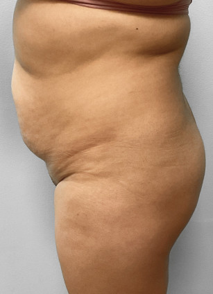 Before Image: Liposuction & BBL Injections- Dr. Howell - left-side