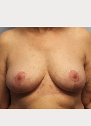 After Image: Breast Implant Removal & Lift- Dr. Howell - front