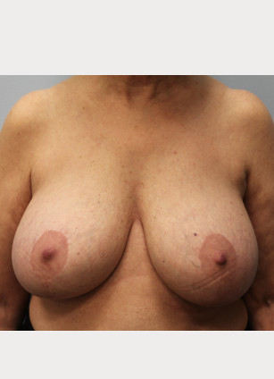 Before Image: Breast Implant Removal & Lift- Dr. Howell - front