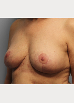 After Image: Breast Implant Removal & Lift- Dr. Howell - left-front-oblique