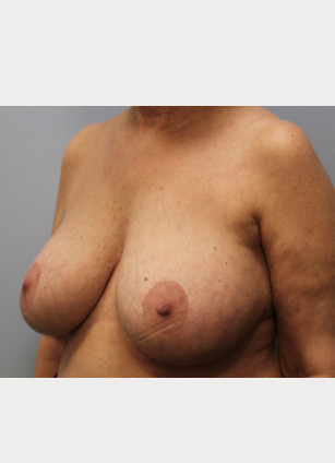 Before Image: Breast Implant Removal & Lift- Dr. Howell - left-front-oblique