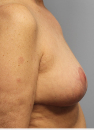 After Image: Breast Implant Removal & Lift- Dr. Howell - right-side