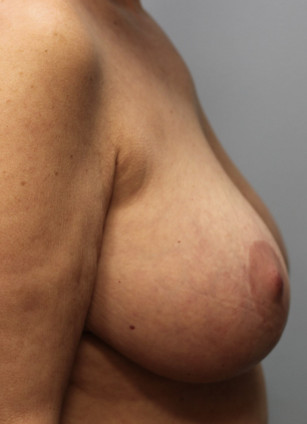 Before Image: Breast Implant Removal & Lift- Dr. Howell - right-side