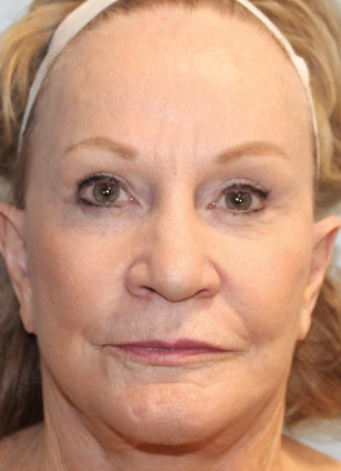 After Image: Facelift, Browlift, & Laser Resurfacing- Dr. Howell - front