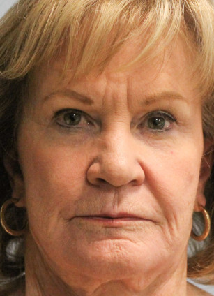 Before Image: Facelift, Browlift, & Laser Resurfacing- Dr. Howell - front