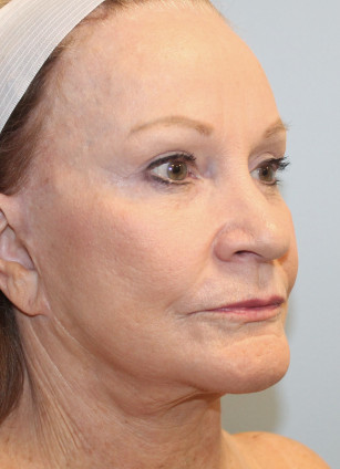 After Image: Facelift, Browlift, & Laser Resurfacing- Dr. Howell - right-front-oblique