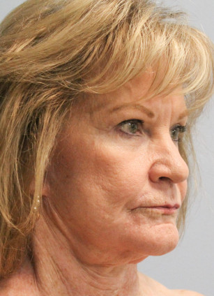 Before Image: Facelift, Browlift, & Laser Resurfacing- Dr. Howell - right-front-oblique