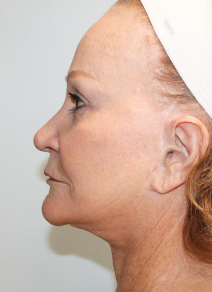 After Image: Facelift, Browlift, & Laser Resurfacing- Dr. Howell - left-side