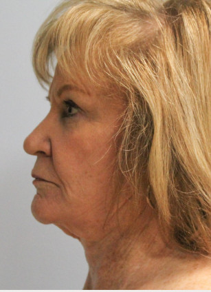 Before Image: Facelift, Browlift, & Laser Resurfacing- Dr. Howell - left-side
