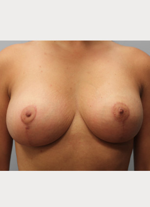 Breast Augmentation & Lift- Dr. Howell
