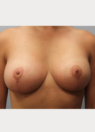 After Image: Breast Augmentation & Lift- Dr. Howell - front