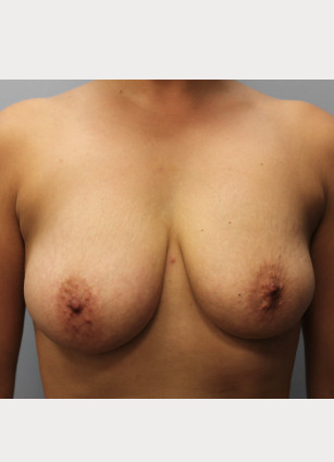 Before Image: Breast Augmentation & Lift- Dr. Howell - front