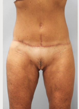 After Image: Body Lift & SmartLipo- Dr. Howell - front